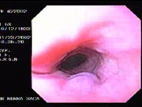 Isolated Varix of the Esophagus