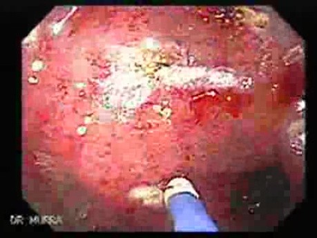 Post-Radiation Colitis (5 of 13)