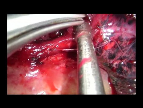 Unisurgeon Uniportal VATS Anatomic Segmentectomy S3 (No Assistant)
