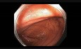Colonoscopy - Cecum - Subtle Lesion