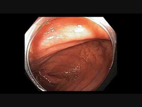 Colonoscopy - Cecum - Subtle Lesion