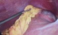 Hydatid cyst and chronic calculous cholecystitis resolved by laparoscopy