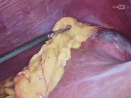 Hydatid cyst and chronic calculous cholecystitis resolved by laparoscopy