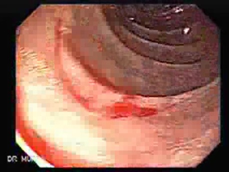 Adenocarcinoma of the cardias (6 of 14)