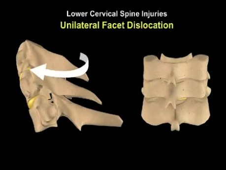 Spine Fractures - Cervical Spine Injury - Video Lecture