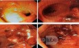 Closure of Rectovaginal Fistula due to Radiation Ischemia for Rectal Cancer After Surgery
