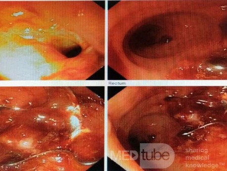 Closure of Rectovaginal Fistula due to Radiation Ischemia for Rectal Cancer After Surgery