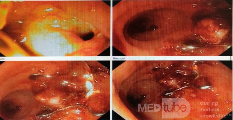 Closure of Rectovaginal Fistula due to Radiation Ischemia for Rectal Cancer After Surgery