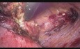 Deep Infiltrating Endometriosis (DIE) of the Bladder Wall