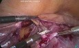 Post Hysterectomy Solid OT in Bag Nila