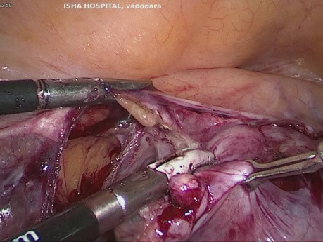 Post Hysterectomy Solid OT in Bag Nila