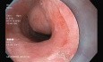 STER Procedure for Esophageal Leiomyoma