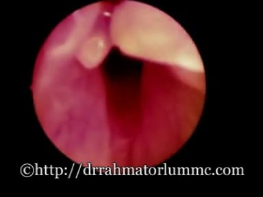 Post-Intubation Injury and Tongues of Granulation Tissue 