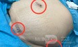 Underbelly Line Sleeve Gastrectomy