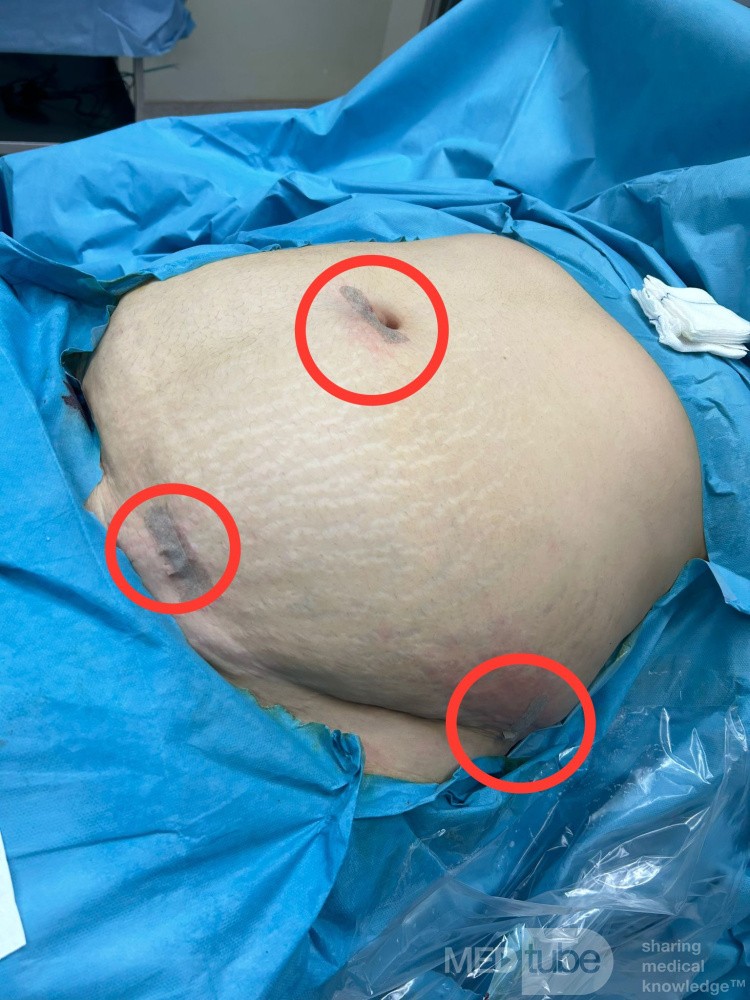 Underbelly Line Sleeve Gastrectomy