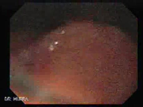 Endoscopy of Mallory Weiss Syndrome - 42 Years-Old Male