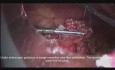Laparoscopic and Endoscopic Cooperative Surgery For Wedge Resection of a Gastric Carcinoid Tumor