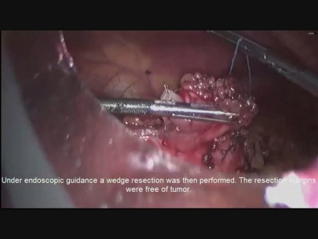 Laparoscopic and Endoscopic Cooperative Surgery For Wedge Resection of a Gastric Carcinoid Tumor