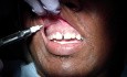 Almost Pain Free Anterior Maxilla Dental Anesthesia: Step 2