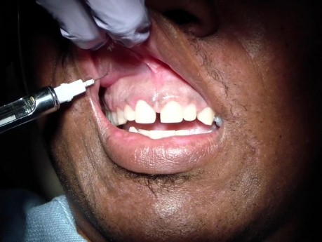 Almost Pain Free Anterior Maxilla Dental Anesthesia: Step 2