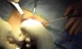 Inguinal hernia prosthetic repair