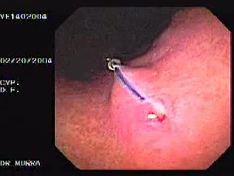 Intraluminal Endoscopic Suturing - Nodule with the Presence of Foreign Body Reaction