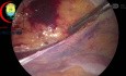 Triangle of Pain in TAPP