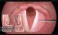 3D Medical Animation - Vocal Cord Reconstruction