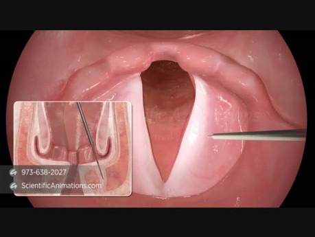 3D Medical Animation - Vocal Cord Reconstruction