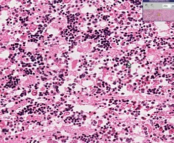 Bone Marrow - Erythroid Hyperplasia