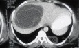 ِAbdominal CT - Liver Hydatid Cyst