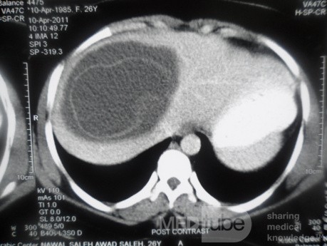 ِAbdominal CT - Liver Hydatid Cyst