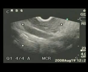 EUS-FNA in diagnosis of IPMT II