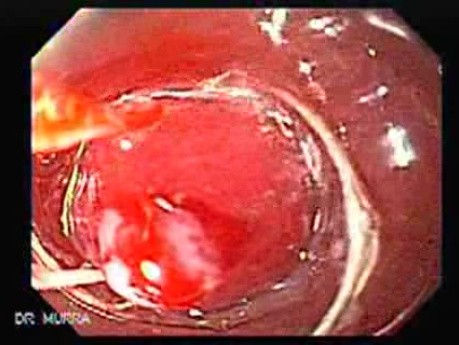 Hyperplastic Polyps - Endoscopy (8 of 14)