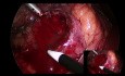 Right Partial Nephrectomy No Ischemia