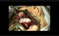 Palatoplasty
