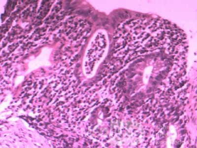 Multiple Rectal Ulcers (29 of 110)