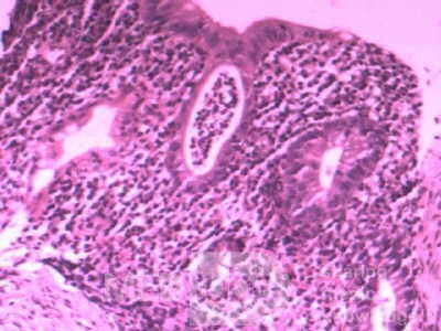 Multiple Rectal Ulcers (29 of 110)