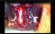 1 Level Stand Alone Anterior Cervical Discectomy and Fusion 