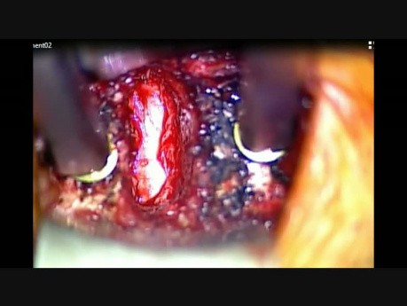 1 Level Stand Alone Anterior Cervical Discectomy and Fusion 