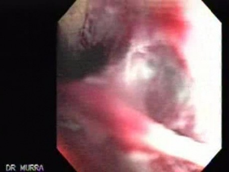 Gastric Cancer - Severe Rebleeding, Part 2