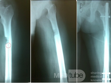 Osteoid Osteoma with Impending Fracture Femur