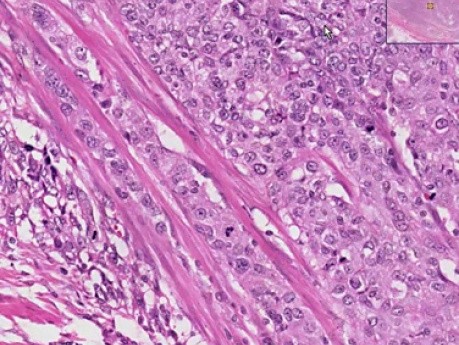Transitional cell carcinoma