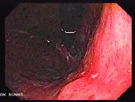 Giant Gastric Ulcer - Endoscopy (5 of 5)