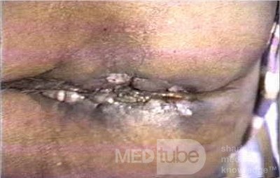 Peri Anal Tuberculosis