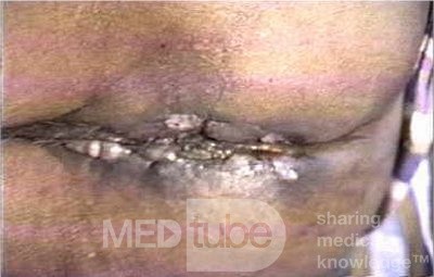 Peri Anal Tuberculosis