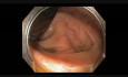 Colonoscopy Channel - Almost Missed Subtle Lesion In The Cecum