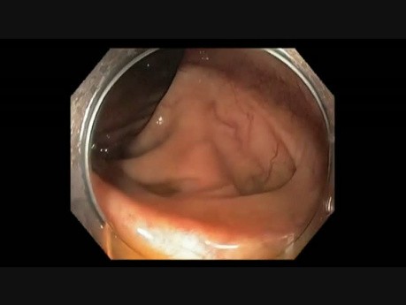 Colonoscopy Channel - Almost Missed Subtle Lesion In The Cecum