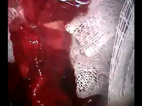 Dissection of Ruptured Aorta Type A - Surgical Repair