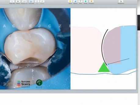 Which is the Best Matrix System for Class II Restorations